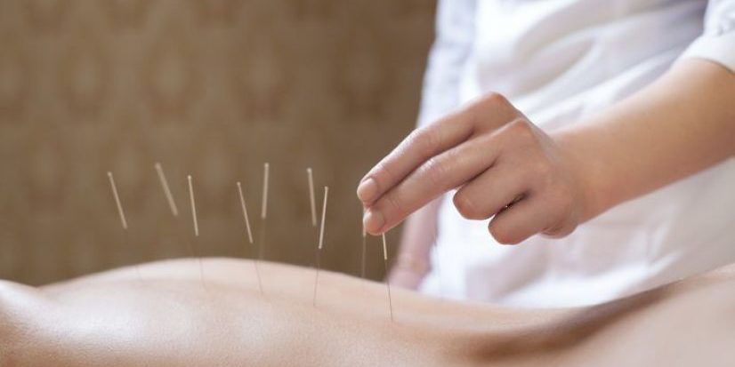 Acupuncture